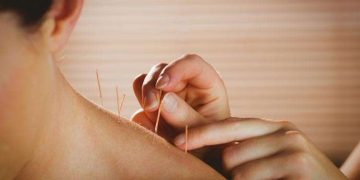   Acupuncture